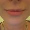 Hyaluronic acid-based wrinkle fillers