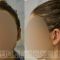 Ear surgery (Otoplasty)
