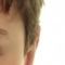 Ear surgery (Otoplasty)