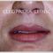 Lip augmentation - cheiloplasty