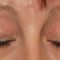 Eyelid surgery (Blepharoplasty)