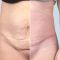 Abdominoplasty (Tummy Tucks)