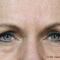Botulinum toxin - Wrinkle Removal