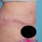 Abdominoplasty (Tummy Tucks)