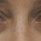 Eyelid surgery (Blepharoplasty)