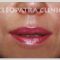 Lip augmentation - cheiloplasty