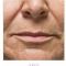 Botulinum toxin - Wrinkle Removal
