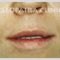 Lip augmentation - cheiloplasty