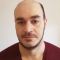 Hair Transplant