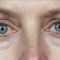 Hyaluronic acid-based wrinkle fillers