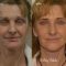 Facelift