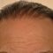 Hair Transplant