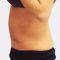 Abdominoplasty (Tummy Tucks)