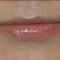 Lip augmentation - cheiloplasty