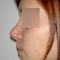 Rhinoplasty (Nose Job)