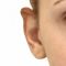 Ear surgery (Otoplasty)