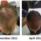 Hair Transplant