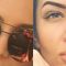 Lip augmentation - cheiloplasty