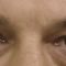 Eyelid surgery (Blepharoplasty)