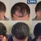 Hair Transplant