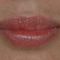 Lip augmentation - cheiloplasty