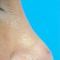 Rhinoplasty (Nose Job)