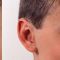 Ear surgery (Otoplasty)