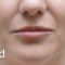 Lip augmentation - cheiloplasty