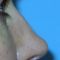 Rhinoplasty (Nose Job)
