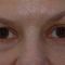 Hyaluronic acid-based wrinkle fillers
