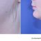 Tumescent liposuction