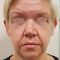 Facelift