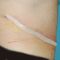 Abdominoplasty (Tummy Tucks)
