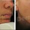 Mesotherapy (face, neck revitalization)
