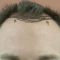 Hair Transplant
