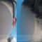 Ear surgery (Otoplasty)