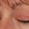 Eyelid surgery (Blepharoplasty)