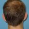 Ear surgery (Otoplasty)