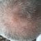 Hair Transplant