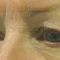 Eyelid surgery (Blepharoplasty)