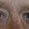 Eyelid surgery (Blepharoplasty)