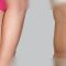 Abdominoplasty (Tummy Tucks)