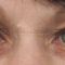 Eyelid surgery (Blepharoplasty)
