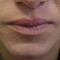 Lip augmentation - cheiloplasty