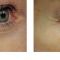 Fotorejuvenation