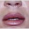 Lip augmentation - cheiloplasty