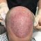 Hair Transplant