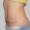 Abdominoplasty (Tummy Tucks)