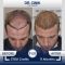 Hair Transplant