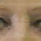 Eyelid surgery (Blepharoplasty)